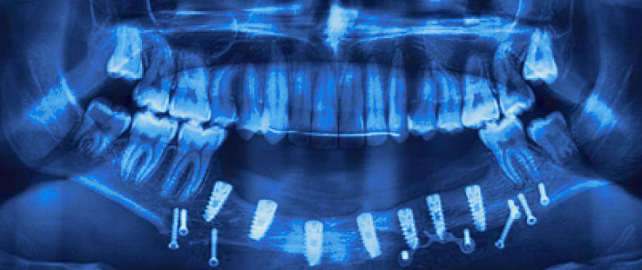 Персонифицированная реабилитация пациентов детского возраста с применением дентальных имплантатов