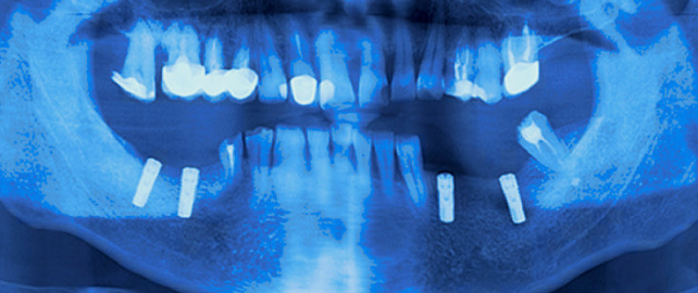 Результаты клинического использования дентальных имплантатов с модифицированной биоактивной поверхностью