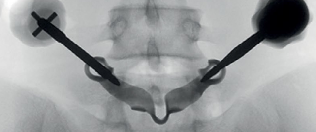 Оперативное лечение двустороннего спондилолиза L5 позвонка у профессиональной гимнастки с использованием индивидуальной конструкции