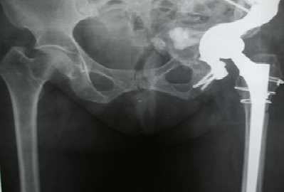The experience of using custom-made implants for gross acetabular defects