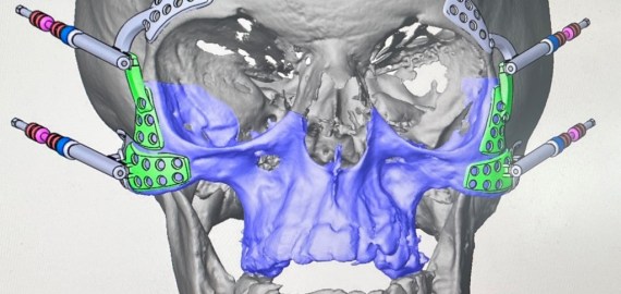 Планирование ортогнатических операций